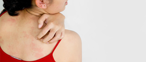 Mencegah Biang Keringat